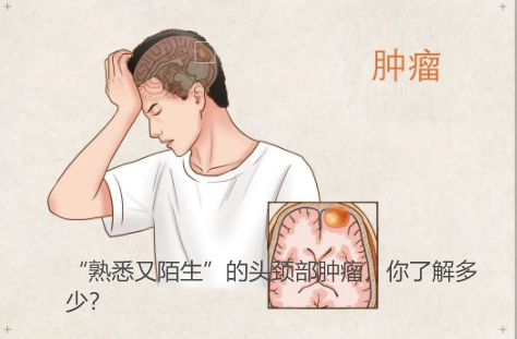 “熟悉又陌生”的头颈部肿瘤，你了解多少？